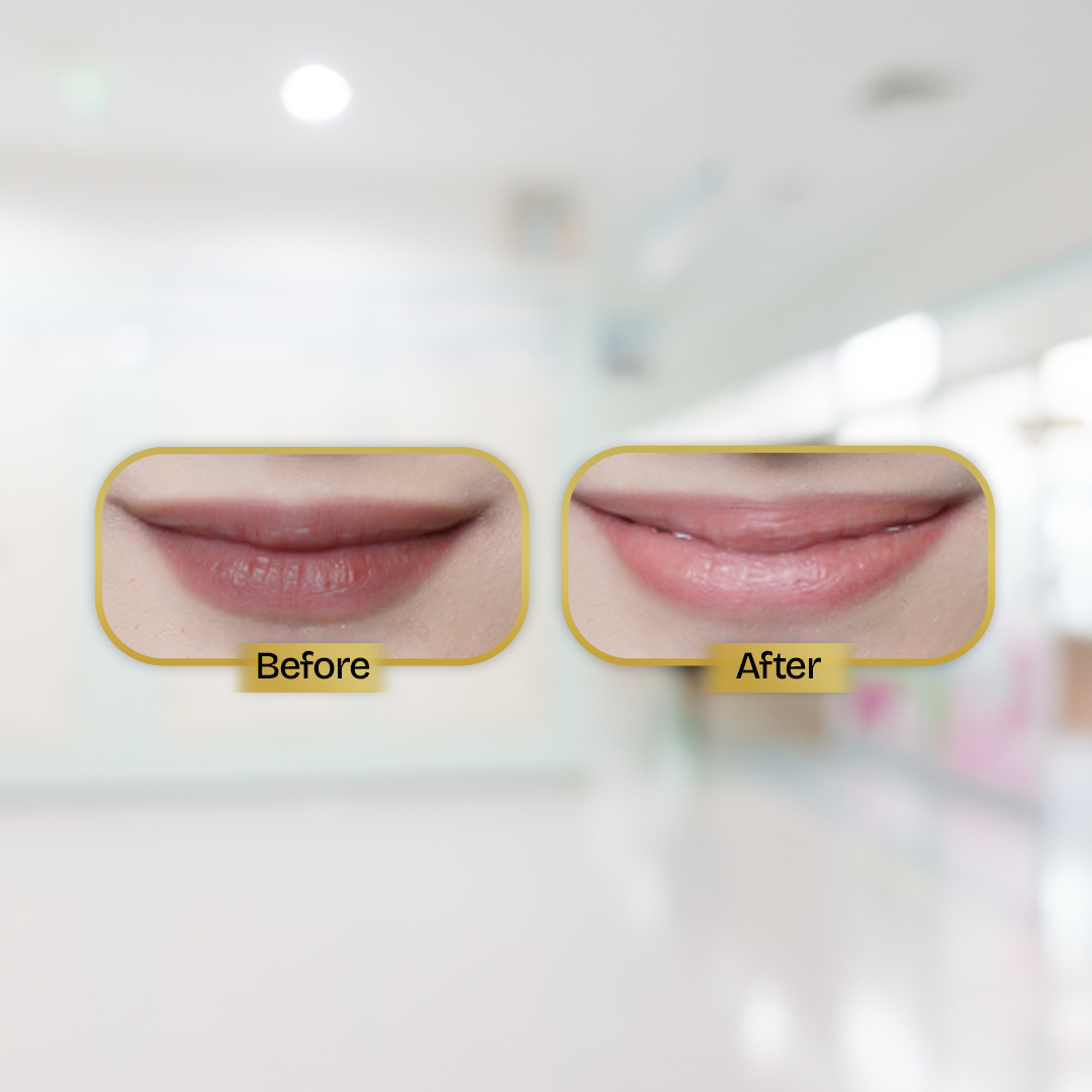 Before and After Treatment