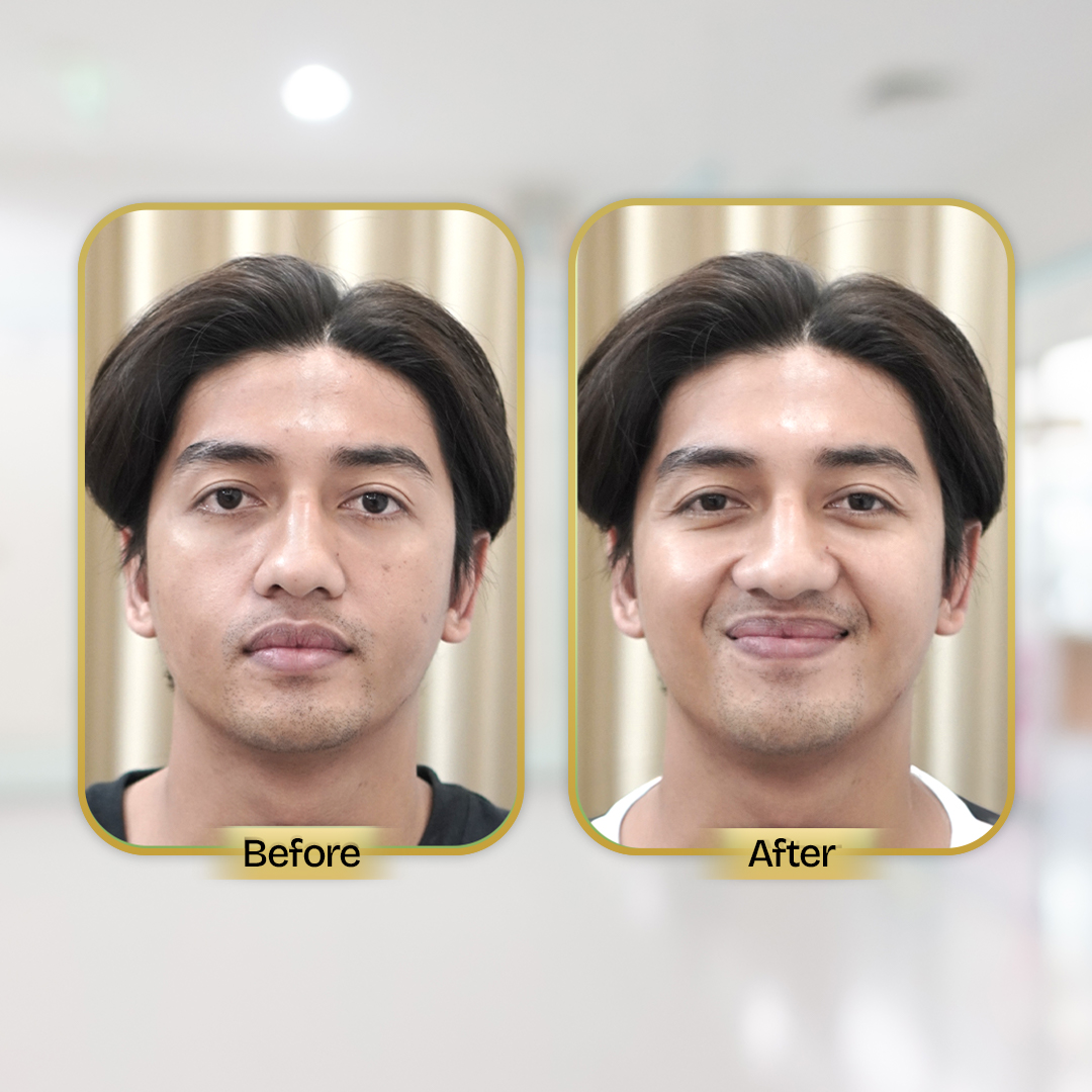 Before and After Treatment