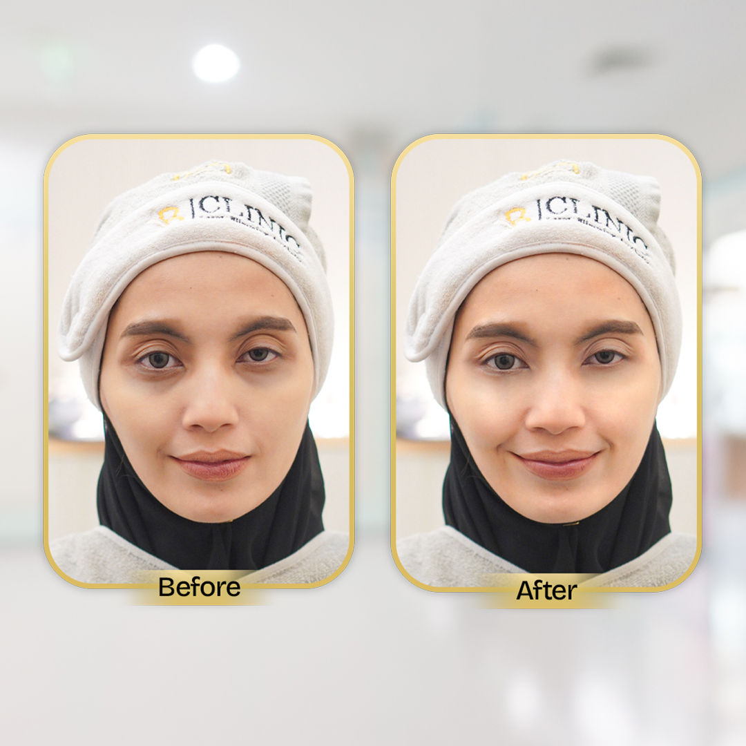 Before and After Treatment