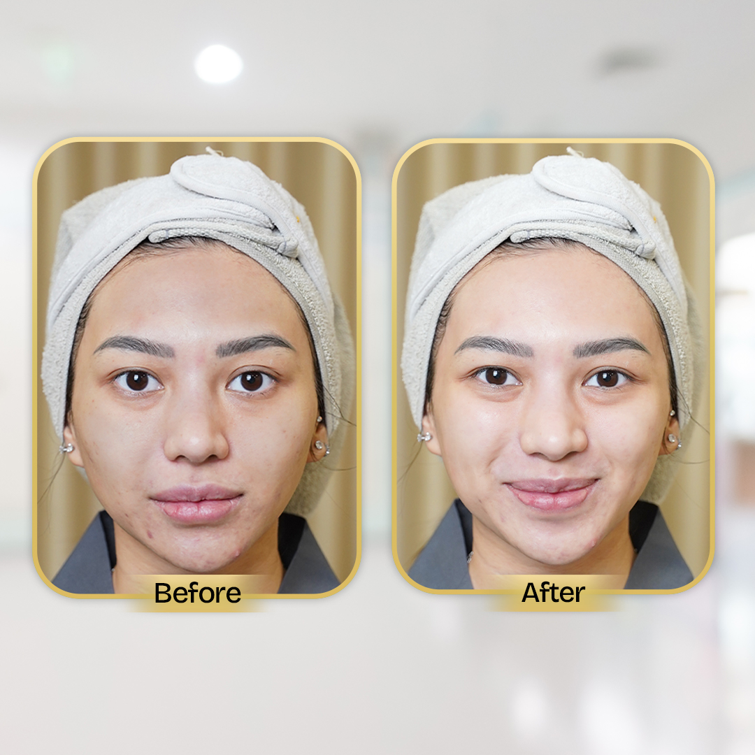 Before and After Treatment