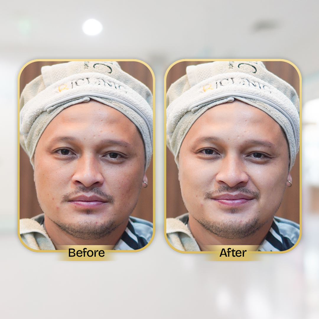 Before and After Treatment