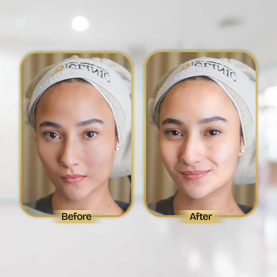 Before and After Treatment
