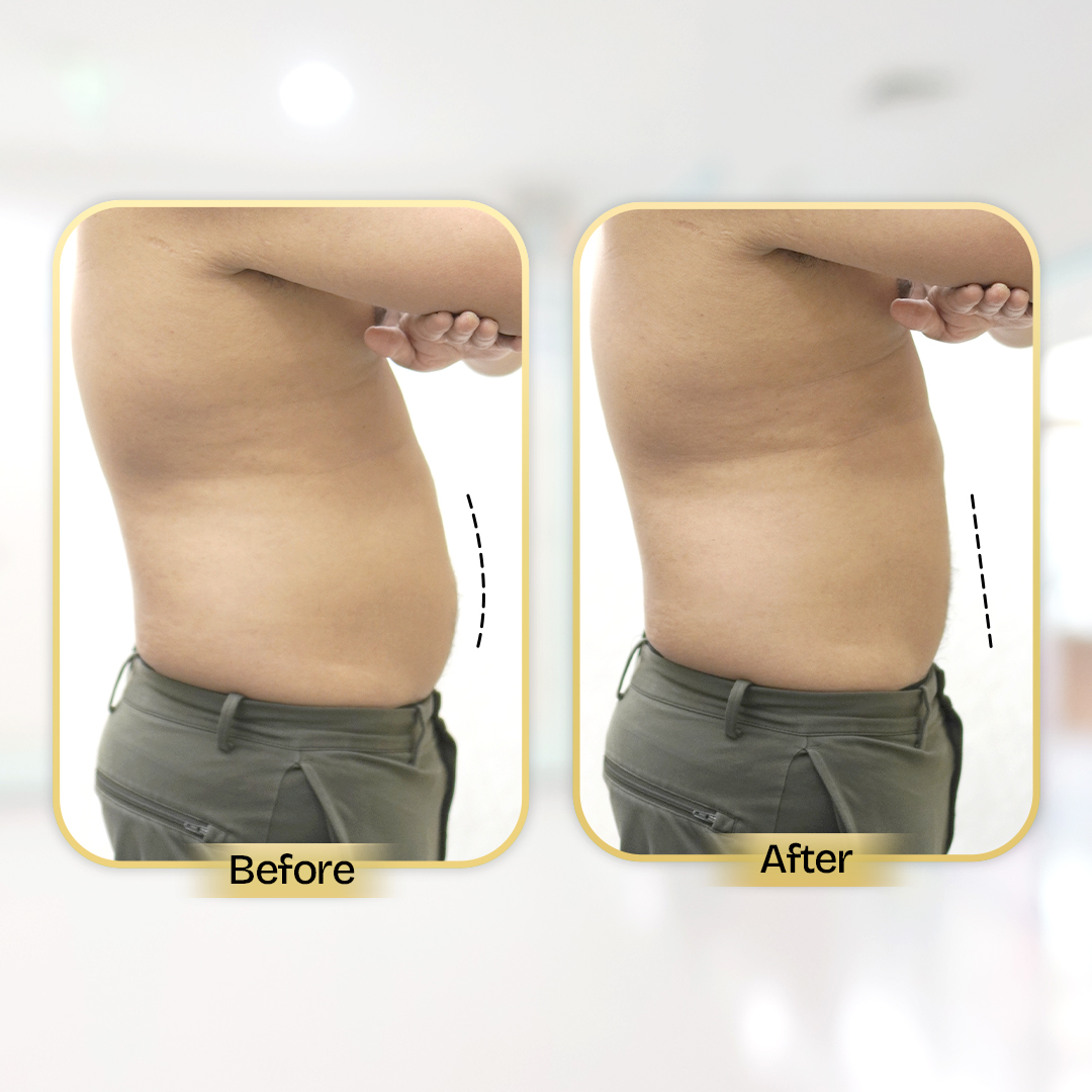 Before and After Treatment