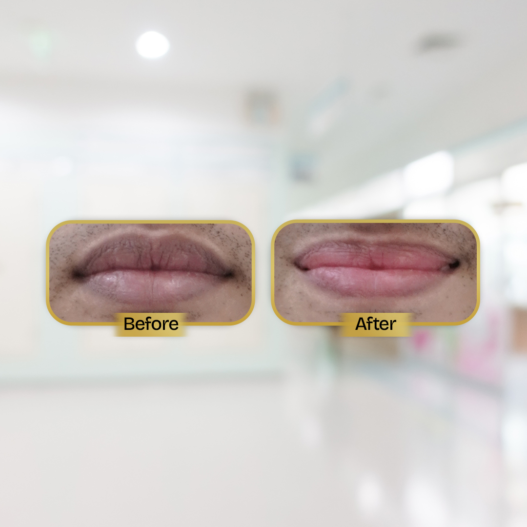 Before and After Treatment
