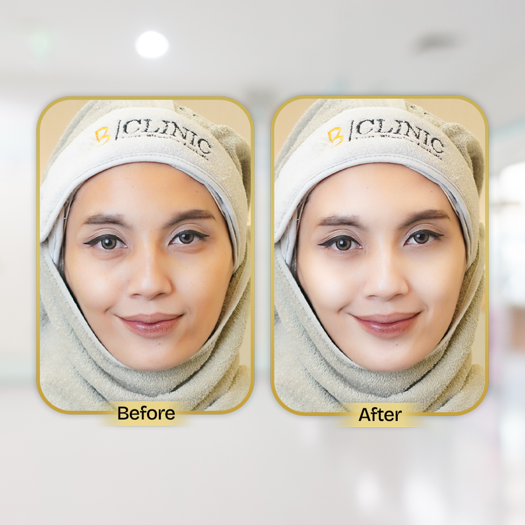 Before and After Treatment